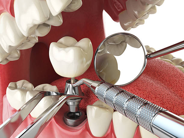 Best Emergency Treatment for Dental Infections or Abscesses in Basking Ridge, NJ